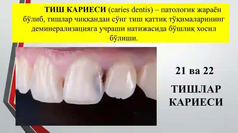 Тишлар кариеси (Dental caries) 3
