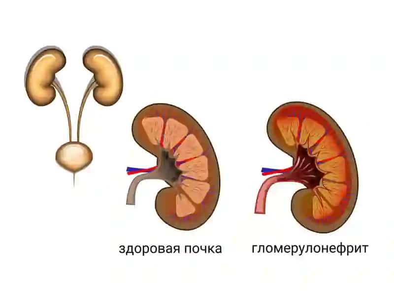 Glomerulonefrit, endokardit, yarali kolit va boshqa kasalliklar kelib chiqishida mikroorganizmlarni ahamiyati 3