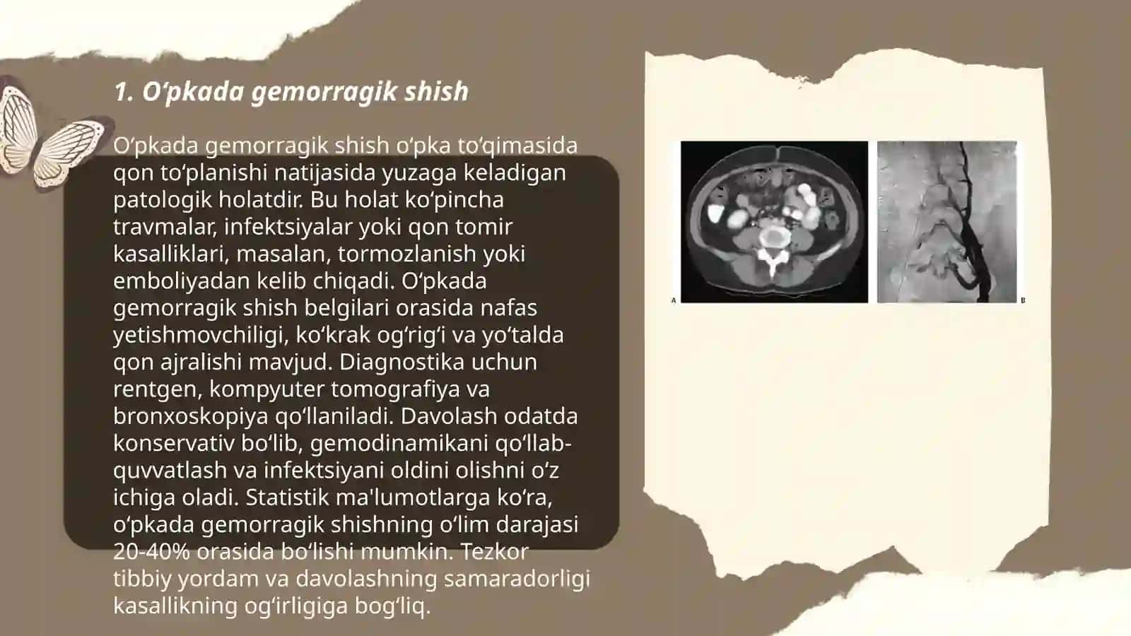 O’pkaning duffiz disseminatsiya sindromi radialogiyas 3