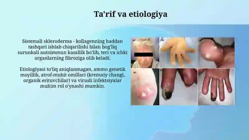 Tizimli sklerodermiya 3
