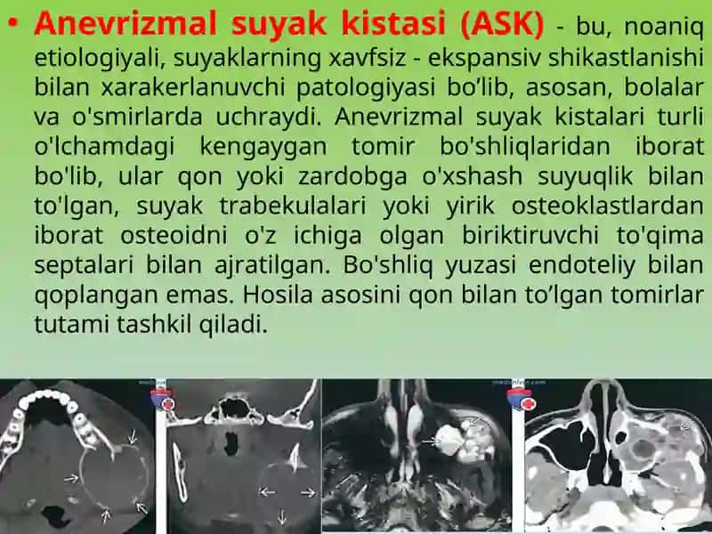 Anevrizmal suyak kistasi 3