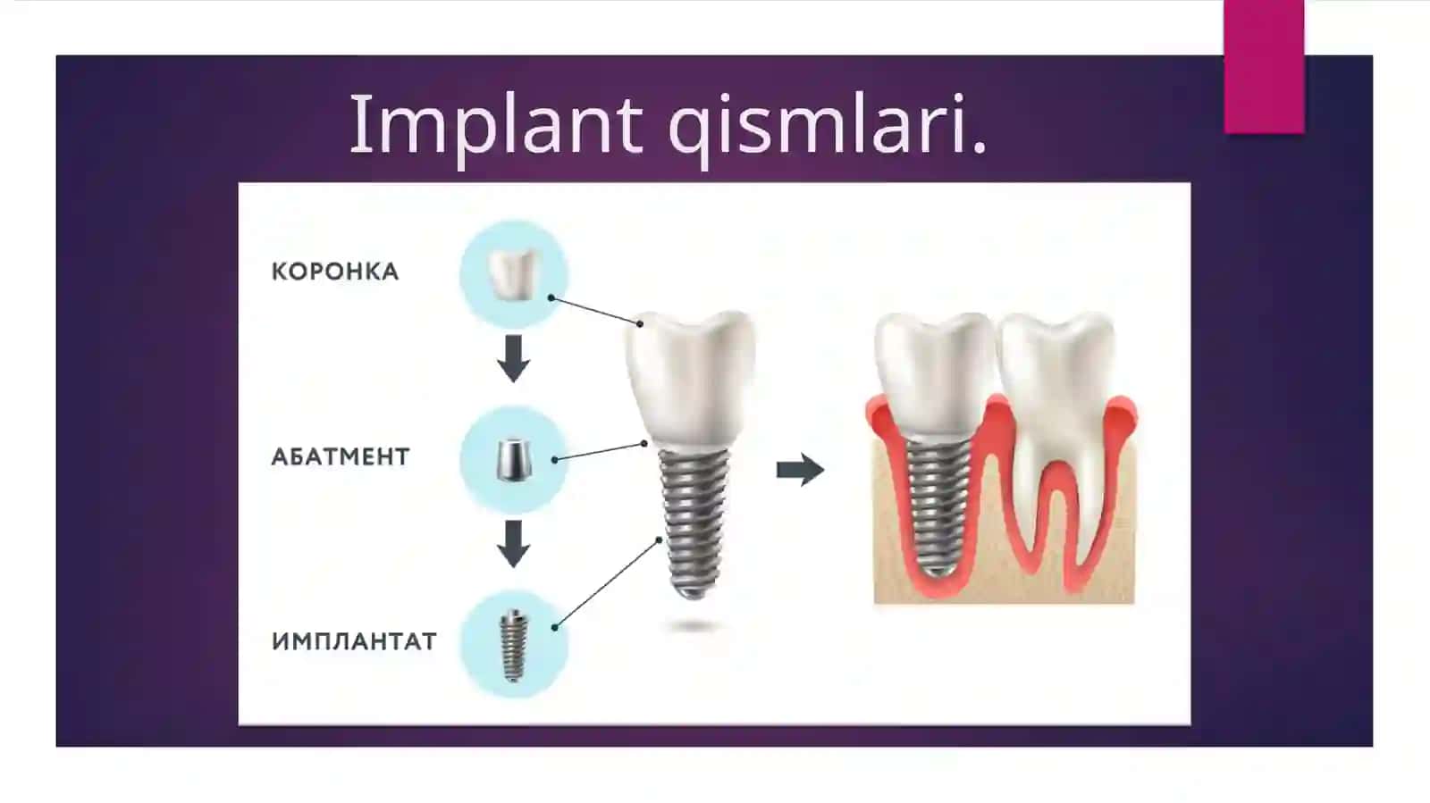 Umumiy amaliyot shifokoristomatologiningzamonaviy klinik protokollar asosida tishimplantlaridanfoydalangan holda tishlarning to'liq yo'qligini davolashni rejalashtirish 3