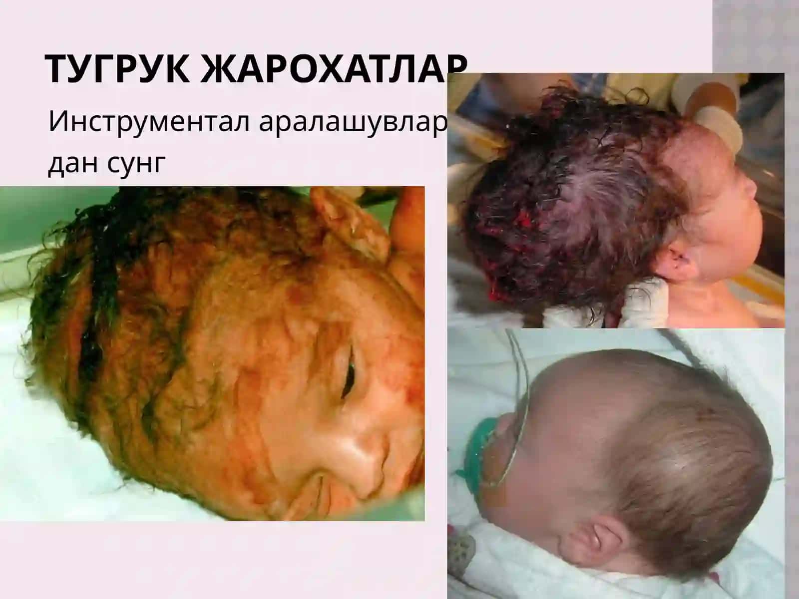 Бош миянинг тугруқ жарохатлари 3