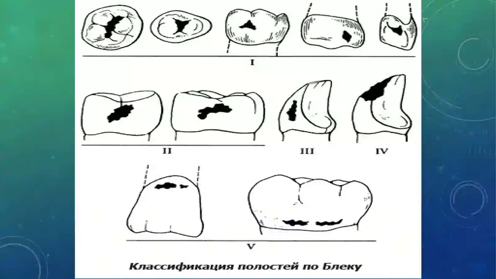 4-SINFKARIOZ KOVAKNI CHARXLASH VA PLOMBALASH 3