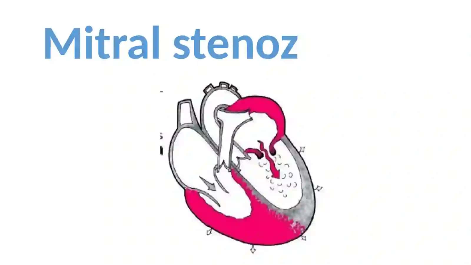 Ortirilgan yurak nuqsonlari. Mitral va aortal nuqsonlar 3