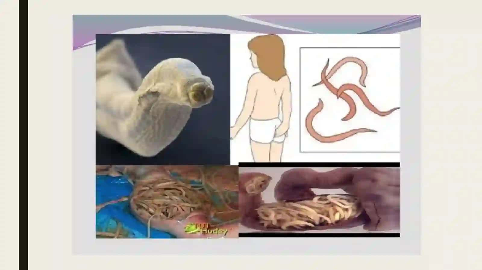 Parazitarinfeksiyalar(malYARIYA, LEYSHMANIOZ, AMEBIAZ) 3