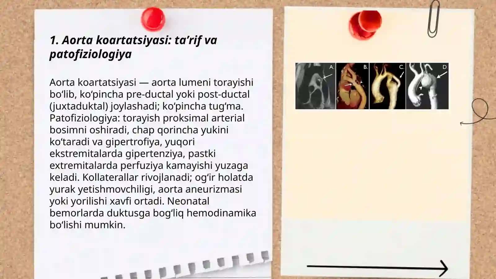 Aorta koartatsiyasi 3