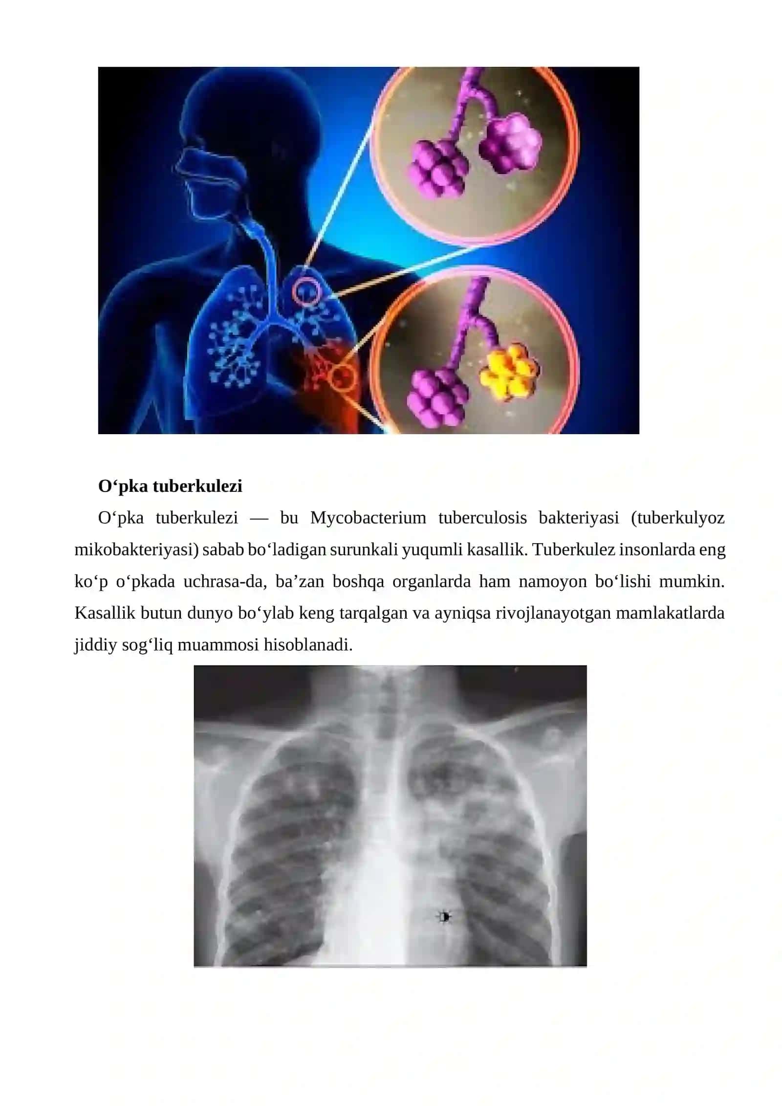 Pnevmoniya, tuberkulez va o‘pka infarkti: etiologiyasi, patogenezi, tasnifi, klinik ko‘rinishi va shakllari 3