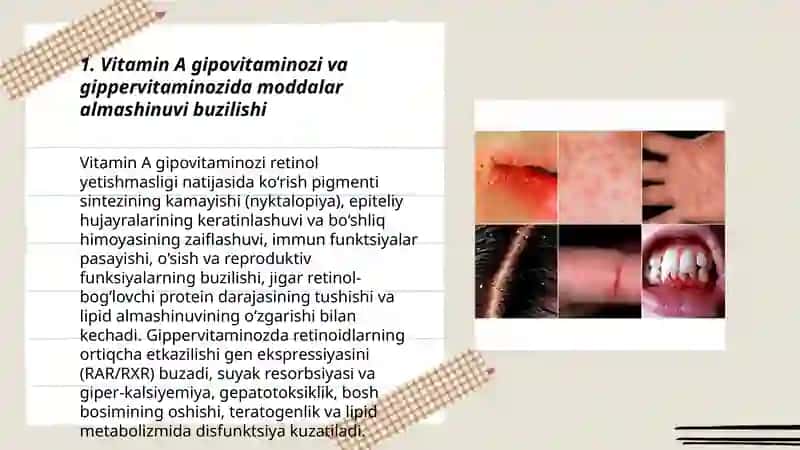 Gipovitaminoz va gippervitaminoz holatlarda moddalar almashinuvini buzilishi 3
