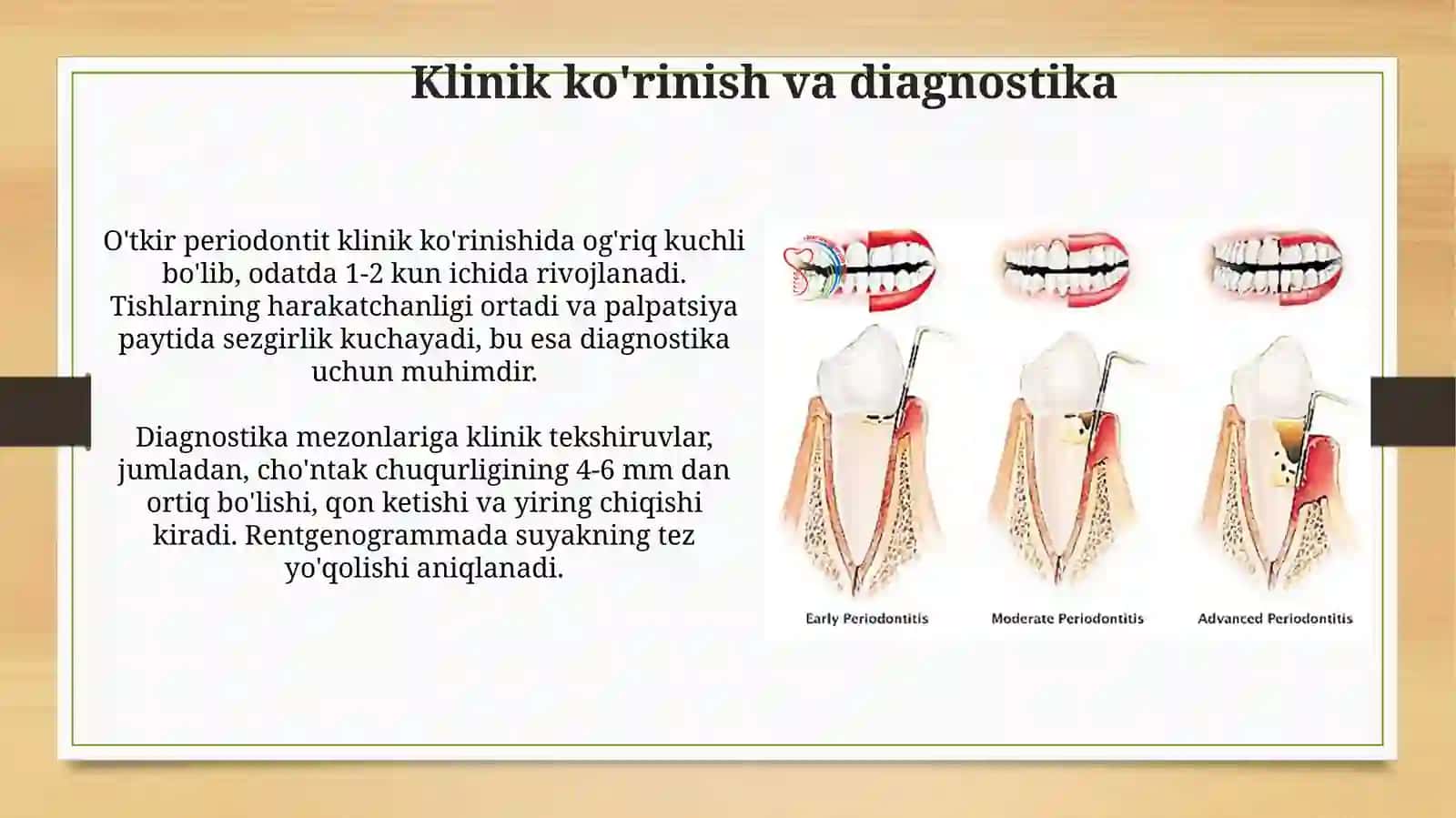 O‘tkir periodontitning klinik kechishi va diagnostikasi 3