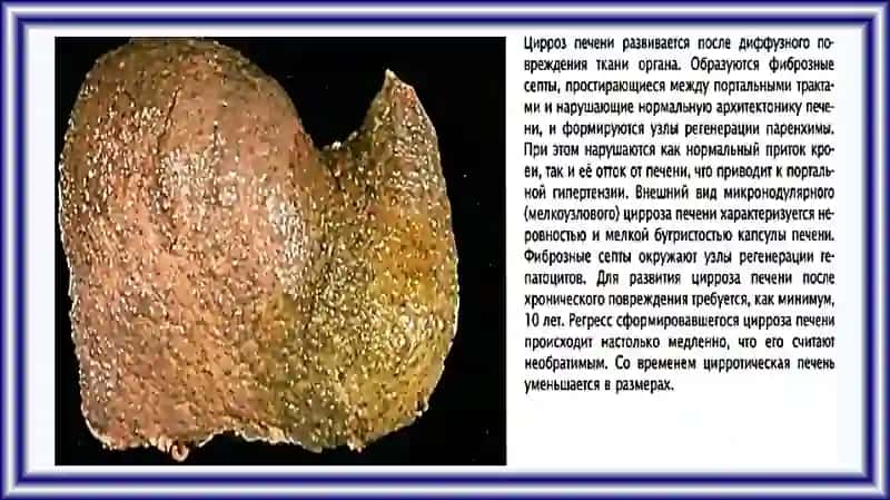ПАТОЛОГИЯ ПЕЧЕНИ И ЖЕЛЧЕВЫВОДЯЩИХ ПУТЕЙ 3