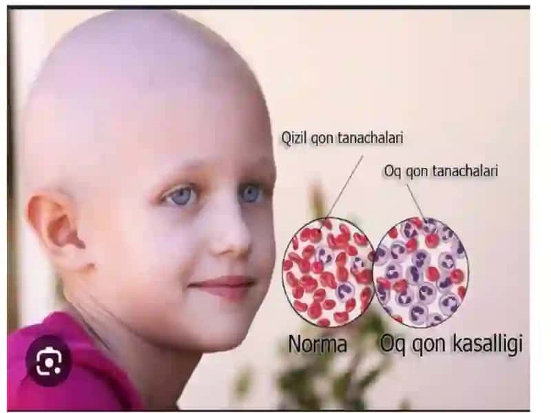 Onkologik kasalliklar bilan ogʼrigan bemorlarlar parvarishi 3