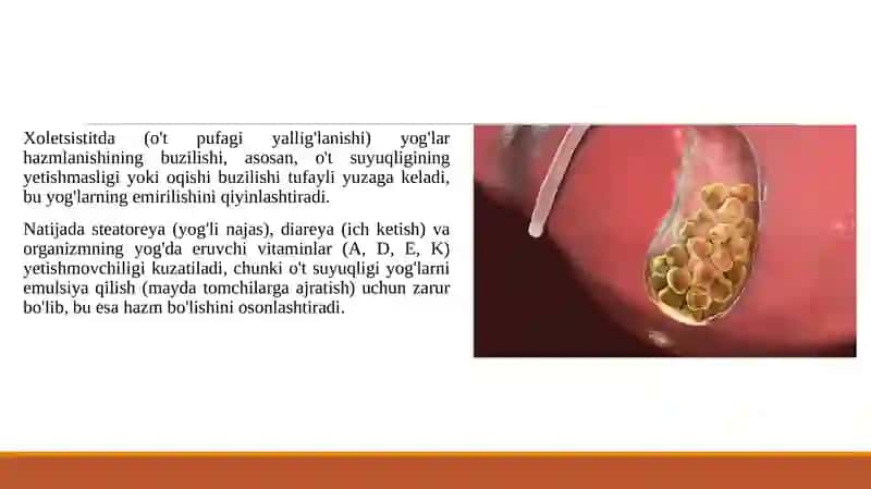 Xoletsistitlarda yogʻlar hazmlanishining buzilishi 3
