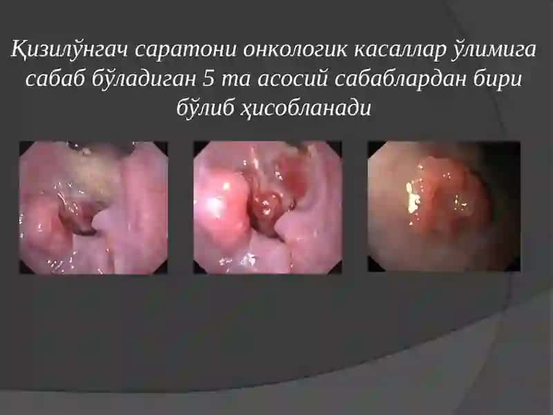 Қизилўнгач саратони 3