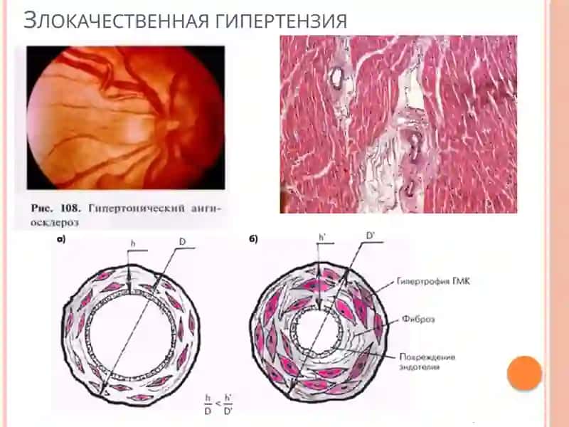 Сосудистая патология. Сосудистые аномалии. Гипертония.  атеросклероз. Аневризмы. Васкулиты. Патология венозных и лимфатических сосудов. Сосудистые опухоли. 3