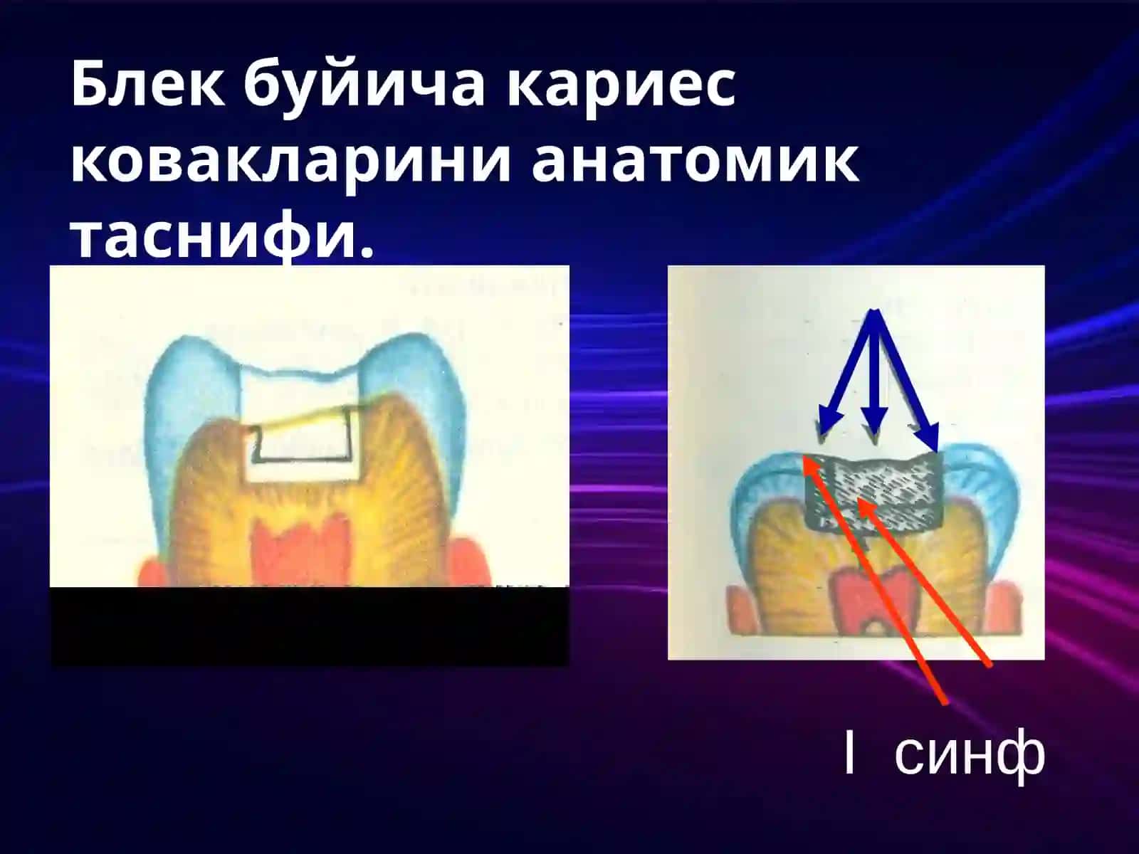 Karies kovagini charxlash bosqichlari 3