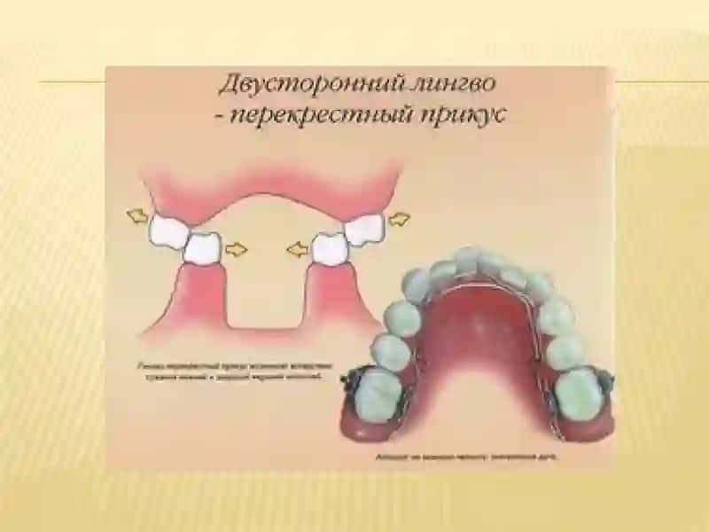 Перекрестный прикус 3