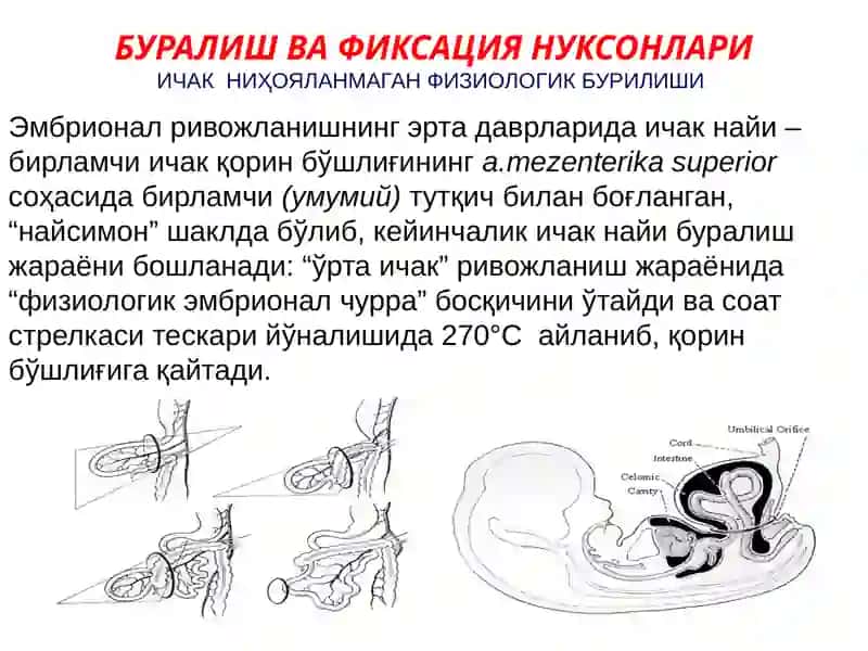 Қорин олд девори, қорин-парда қин ўсимтасининг ривожланиш нуқсонлари ва аномалиялари 3