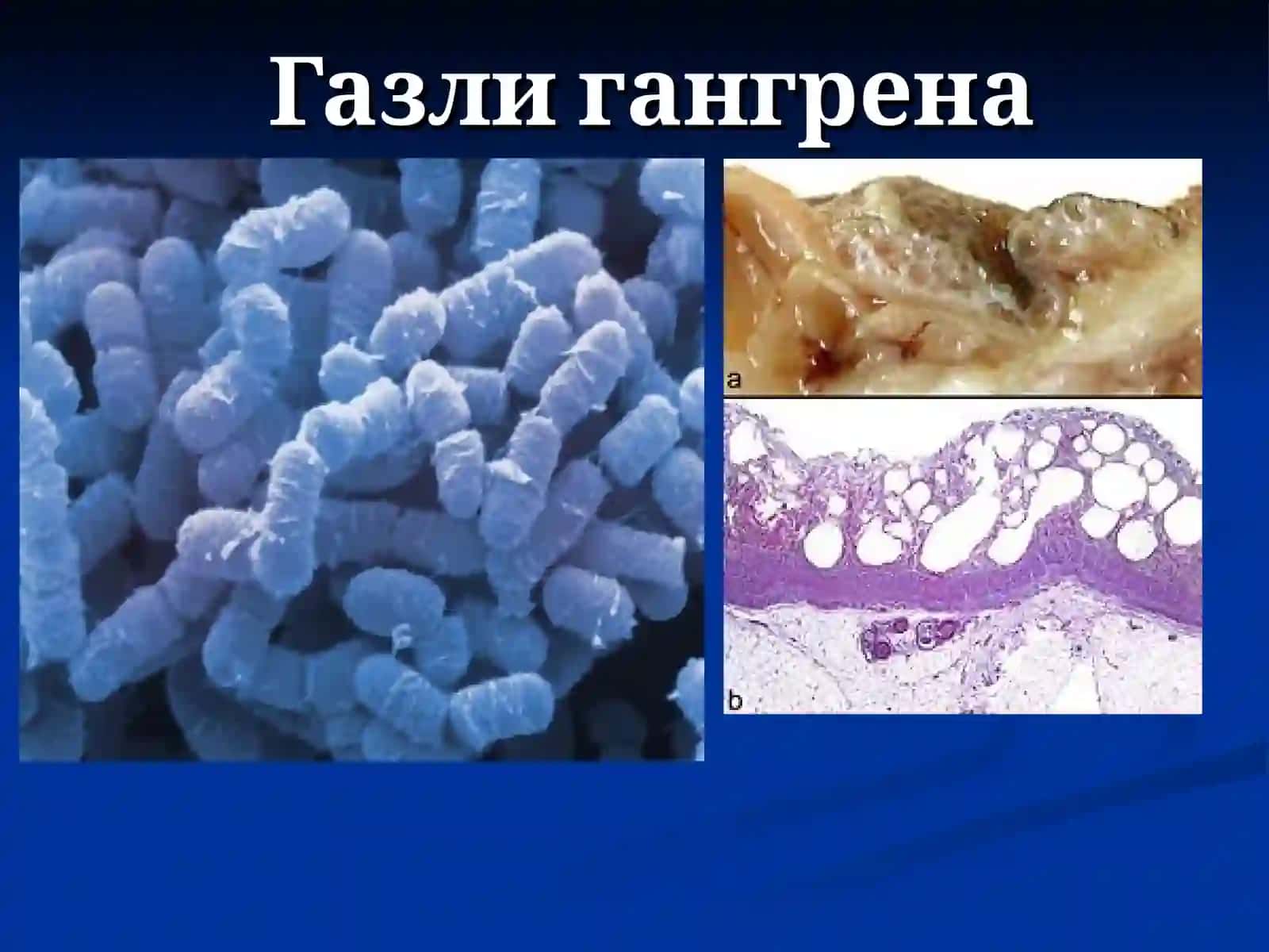 Жарохат инфекцияси.Кокшол, Газли гангрена 3