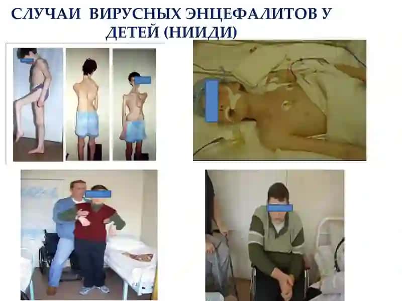 ЭНЦЕФАЛИТЫ 3