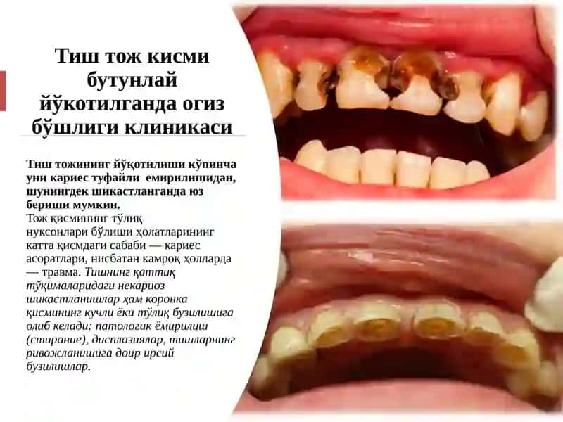 Тиш тож қисми бутунлай йўқотилганда оғиз бўшлиғининг клиникаси ва протезлаш усуллари 3