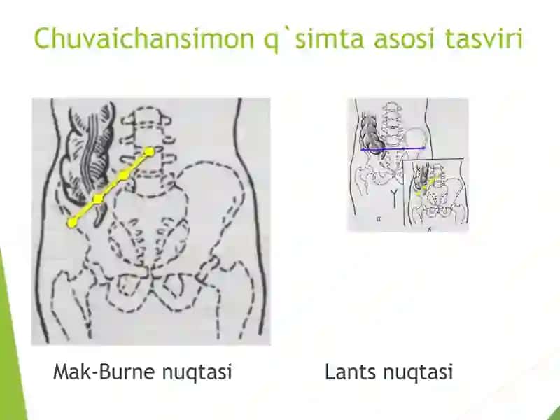 Qorin old-yon devori rivojlanish nuqsonlarida operatsiyalar 3