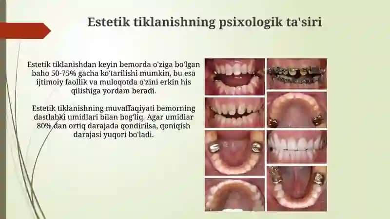 Tishlarni estetik restavratsiya gilishning psixologik jihatlari 3