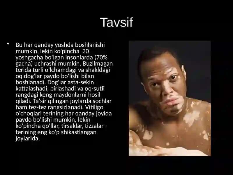 Vitiligo 3