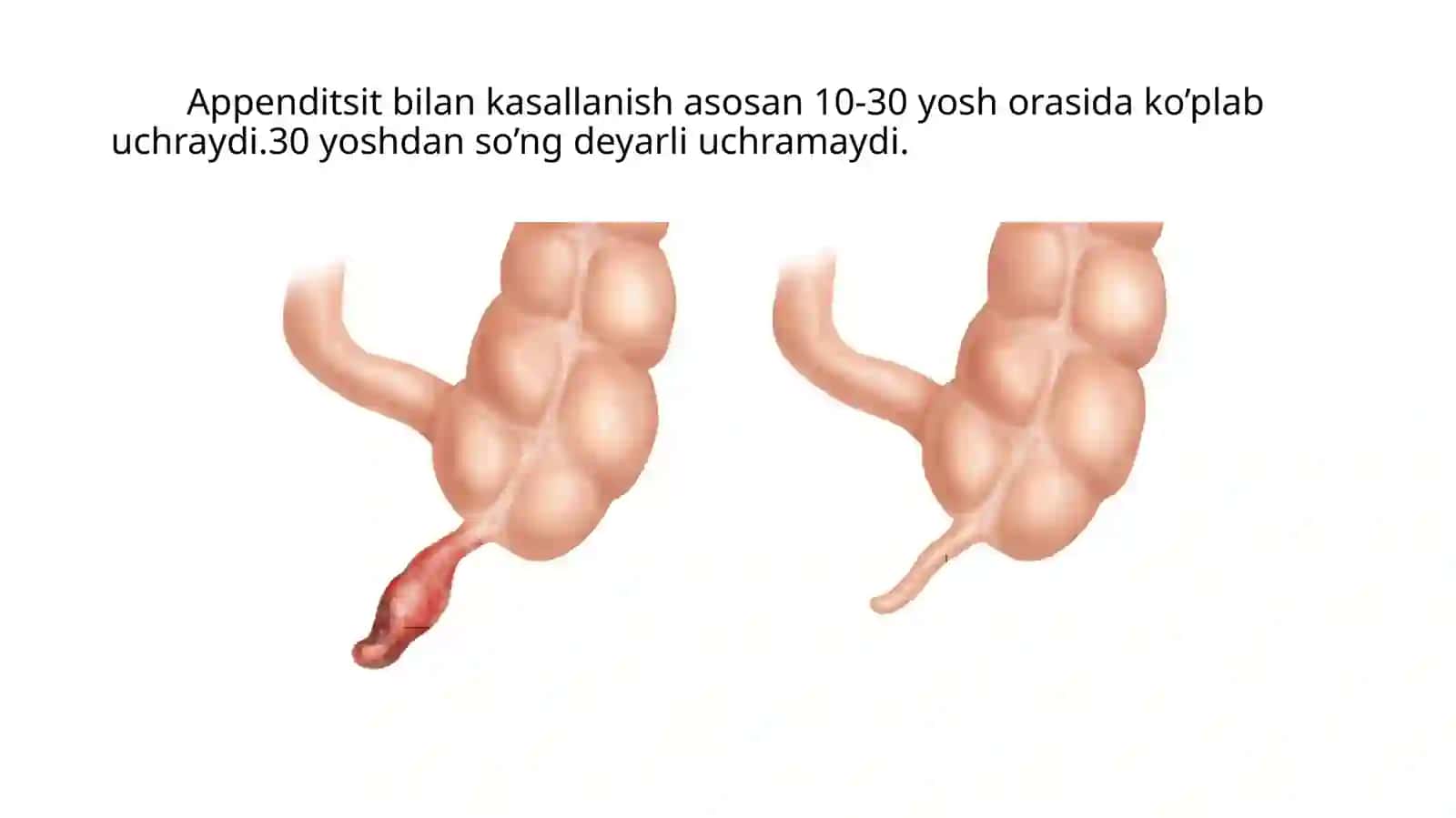 O’tkir appenditsit 3