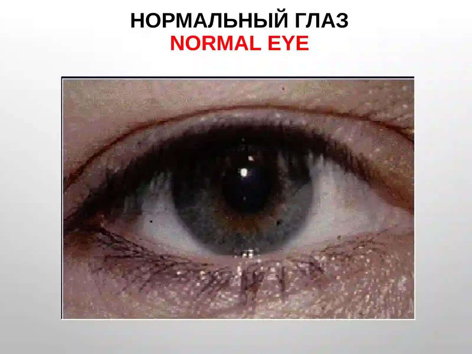 Воспалительные заболевания век, конъюнктивы, склеры и слезного аппарата 3