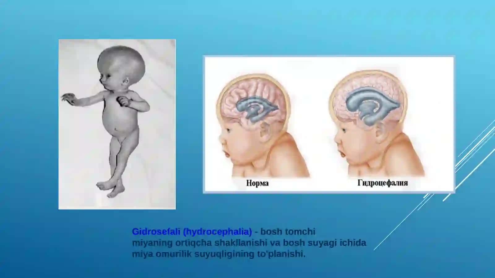 Bosh va orqa miya tug’marivojlanish nuqsonlari 3