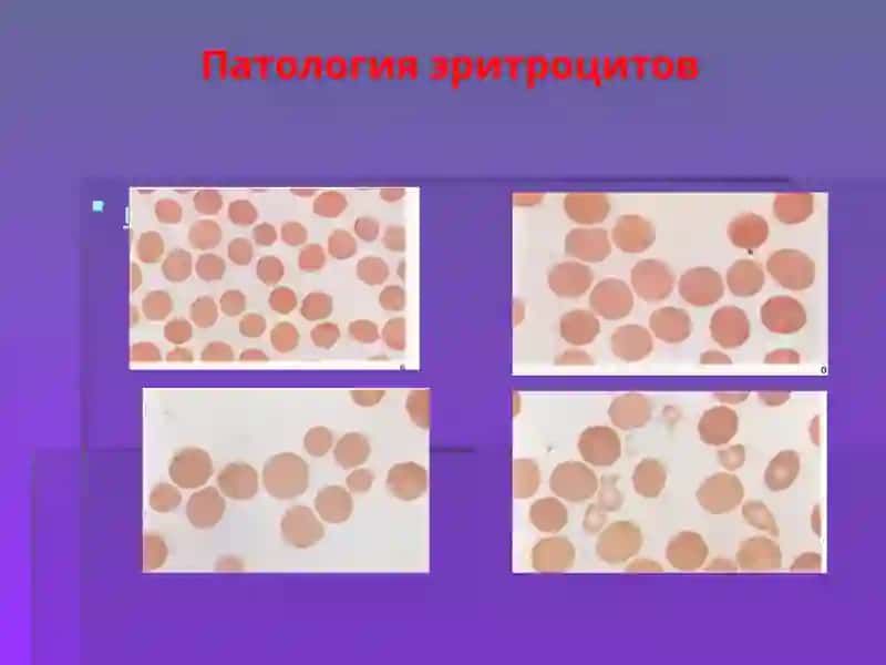 Анемия 3
