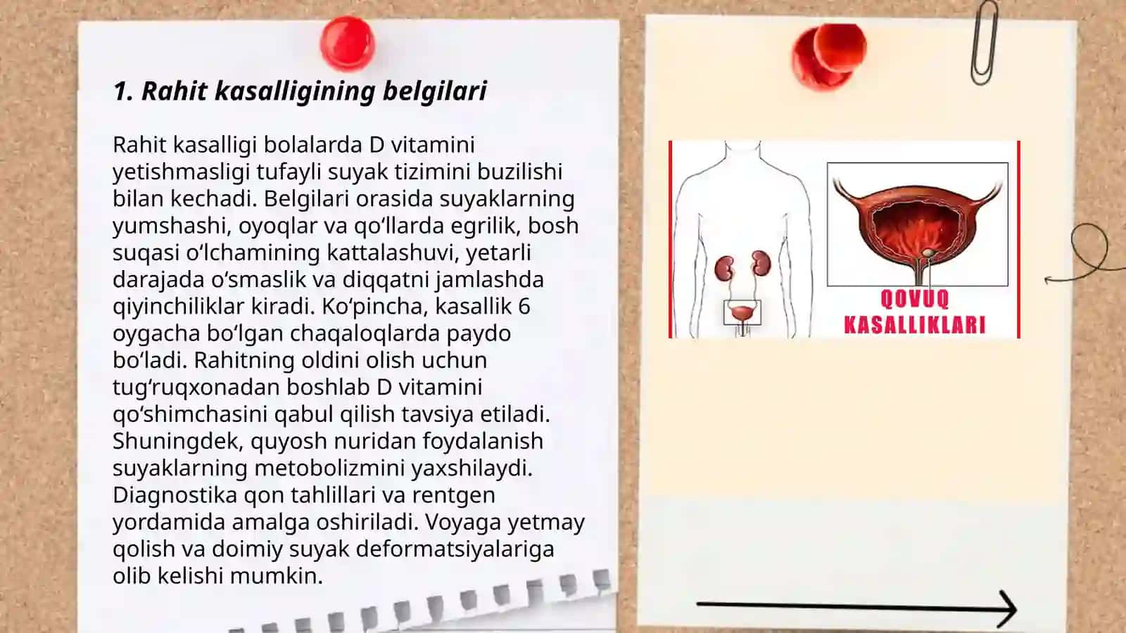 Bolalarda rahit kasalligi 3