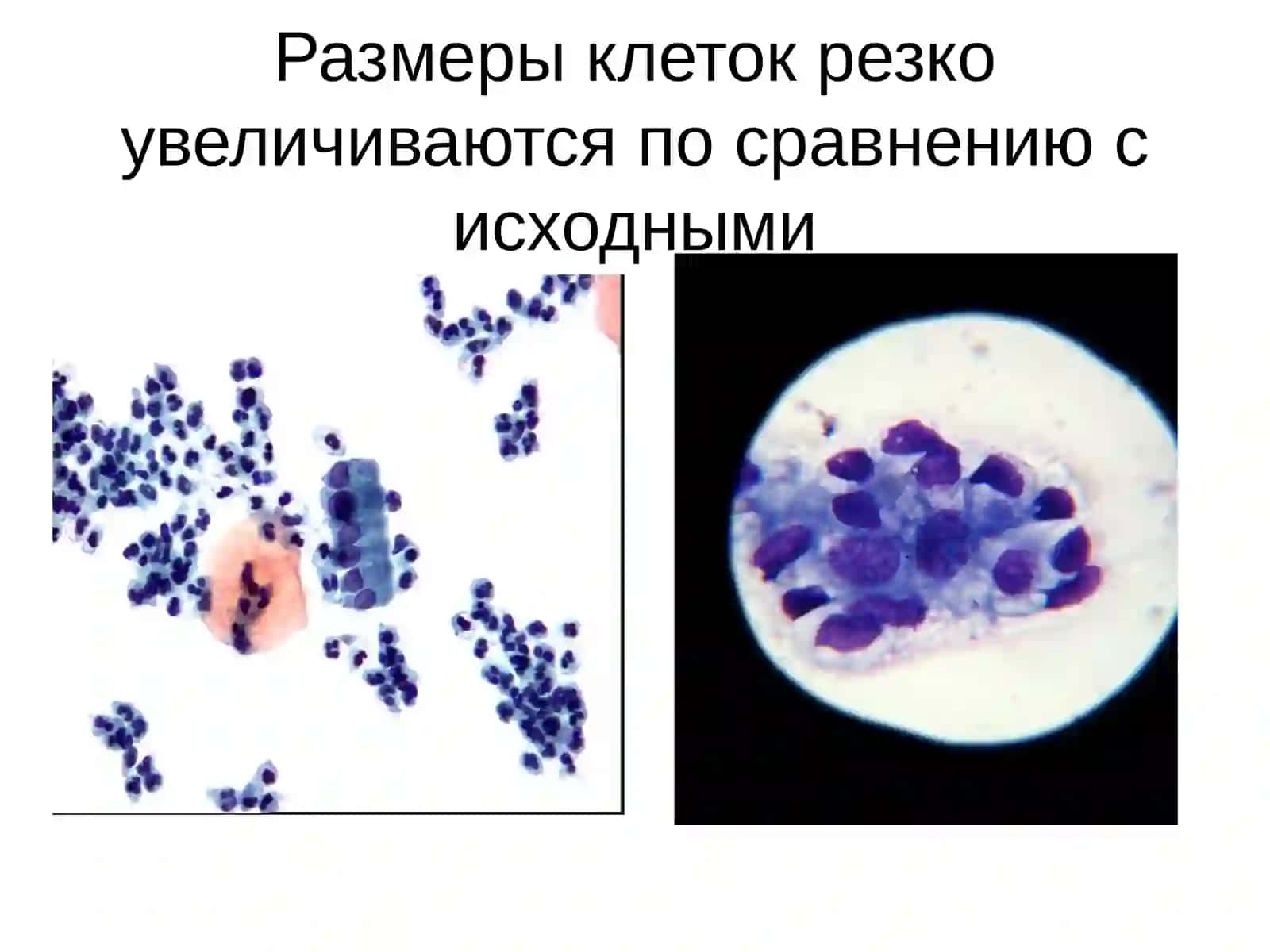 Определение злокачественности клеточных элементов 3