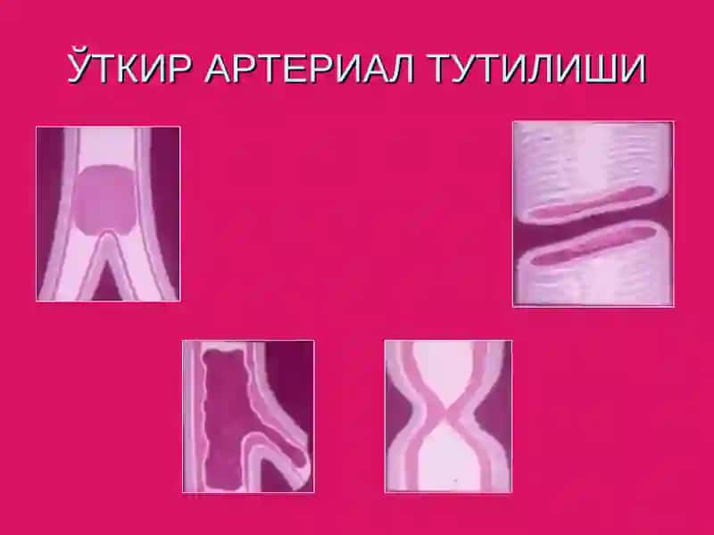 Ўткир артериал тромбози ва эмболиялари 3