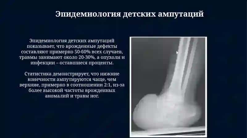 Особенности ампутаций у детей 3