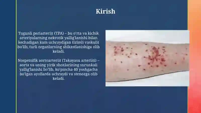 Tugunchali periartrit,nospetsifik aortaartrit kasalliklari diagnostikasi 3