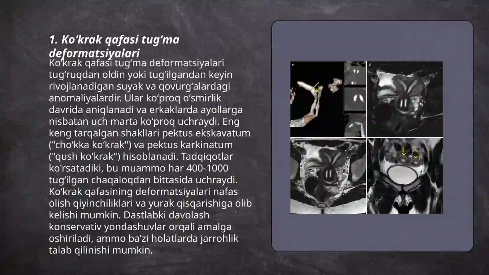 Koʻkrak qafasi tugʻma va olingan anomaliyalari 3