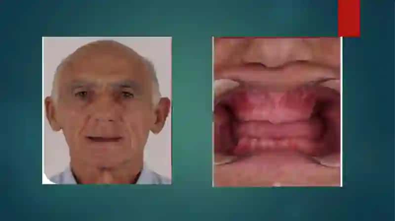 Tishsiz bemorlarda ortodontik davolash 3
