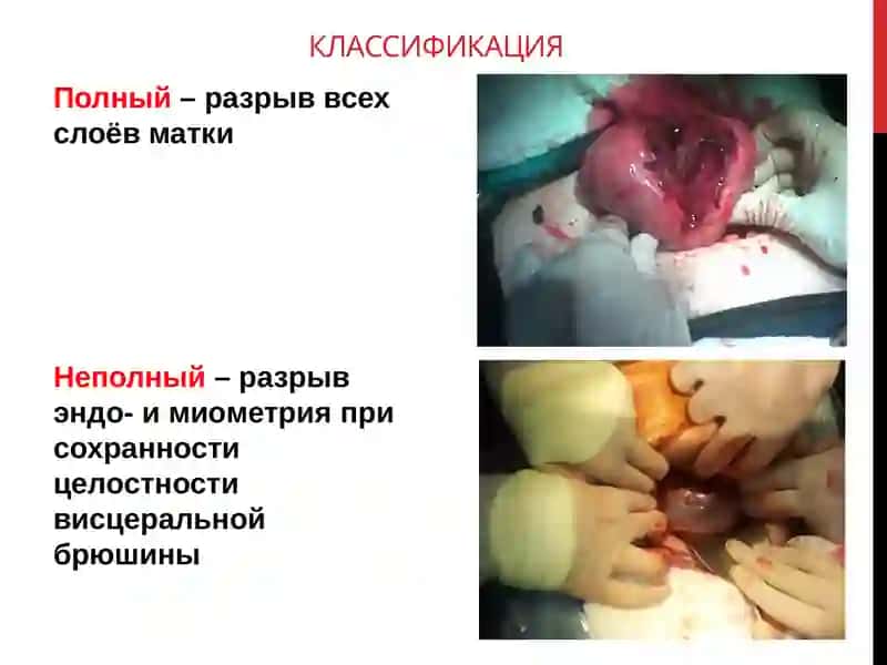 РАЗРЫВЫ МАТКИ 3