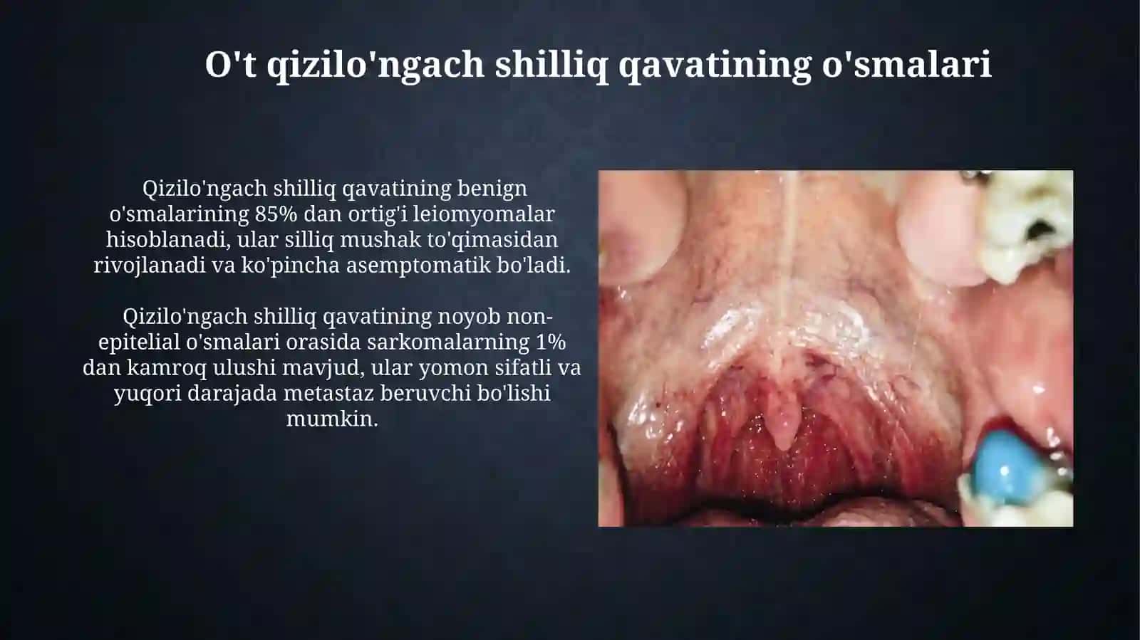 O't qizilo'ngach shilliq qavatining o'smalari 3