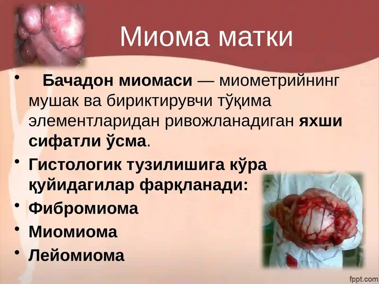Аёллар жинсий аъзоларининг яхши сифатли ва ёмон сифатли ўсмалари 3