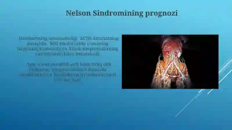 Nelson Sindromi: Ta'rif va Etiologiya 3