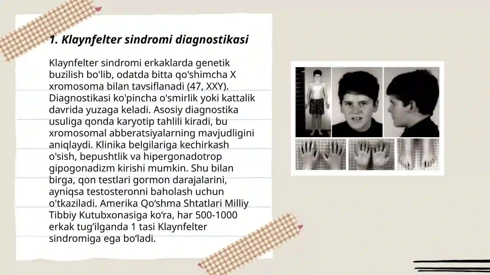Klaynfelter sindromi 3