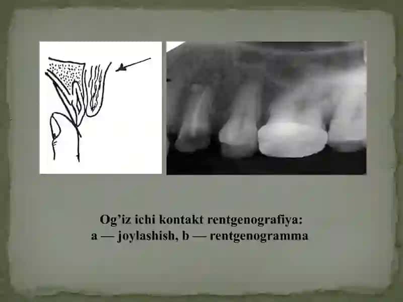 Dental rentgenogrammaning og’iz ichi (intraoral) usuli. Intraoral dental rentgenografiyaning turlari. O’tkazish metodikasi. Afzalliklari va kamchiliklari. Ko’rsatma va qarshi ko’rsatmalar. Olingan rentgenogrammani tahlili. 3