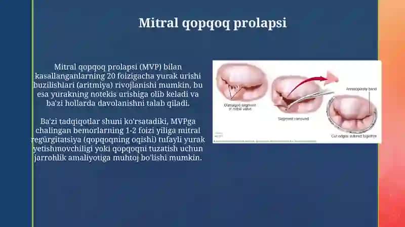 Mitral qopqoq prolapsi 3