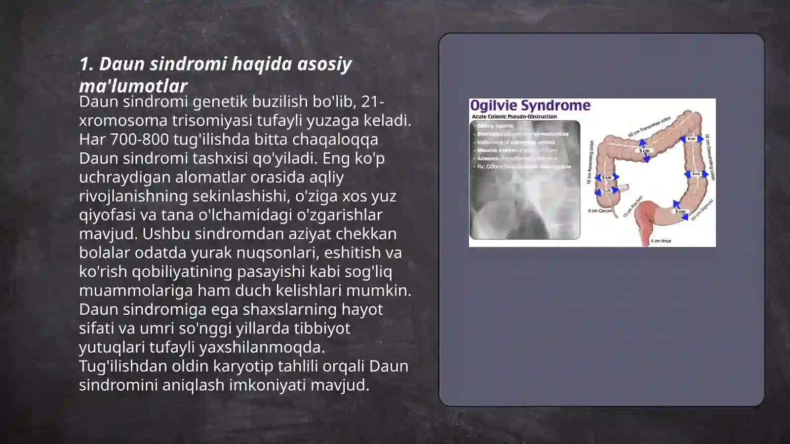 Daun sindromi va daun sindromi bilan tug’ilgan mashhurlar 3