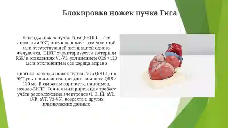 Блокировка ножек пучка Гиса 3