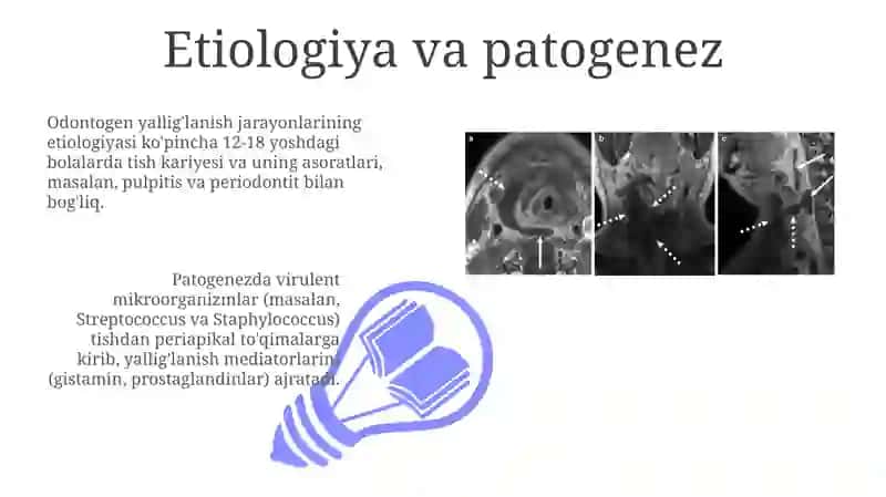 Bolalarda odontogenyallig'lanish jarayonlari: limfoadenit, absess, flegmonalar 3