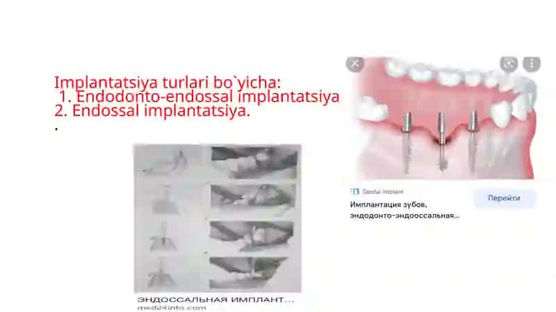 IMPLANTANTLAR TASNIFI 3